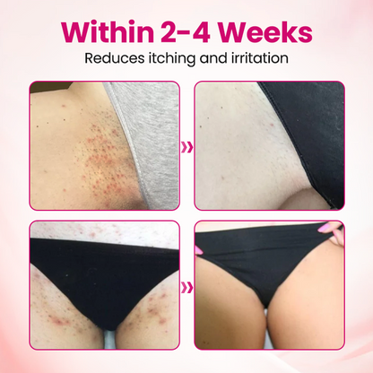 🏆 Breakthrough in Women's Intimate Health! Feel Relief in Just 3 Days with Multi-Targeted HPV Defense