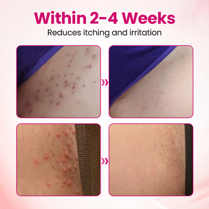 🏆 Breakthrough in Women's Intimate Health! Feel Relief in Just 3 Days with Multi-Targeted HPV Defense